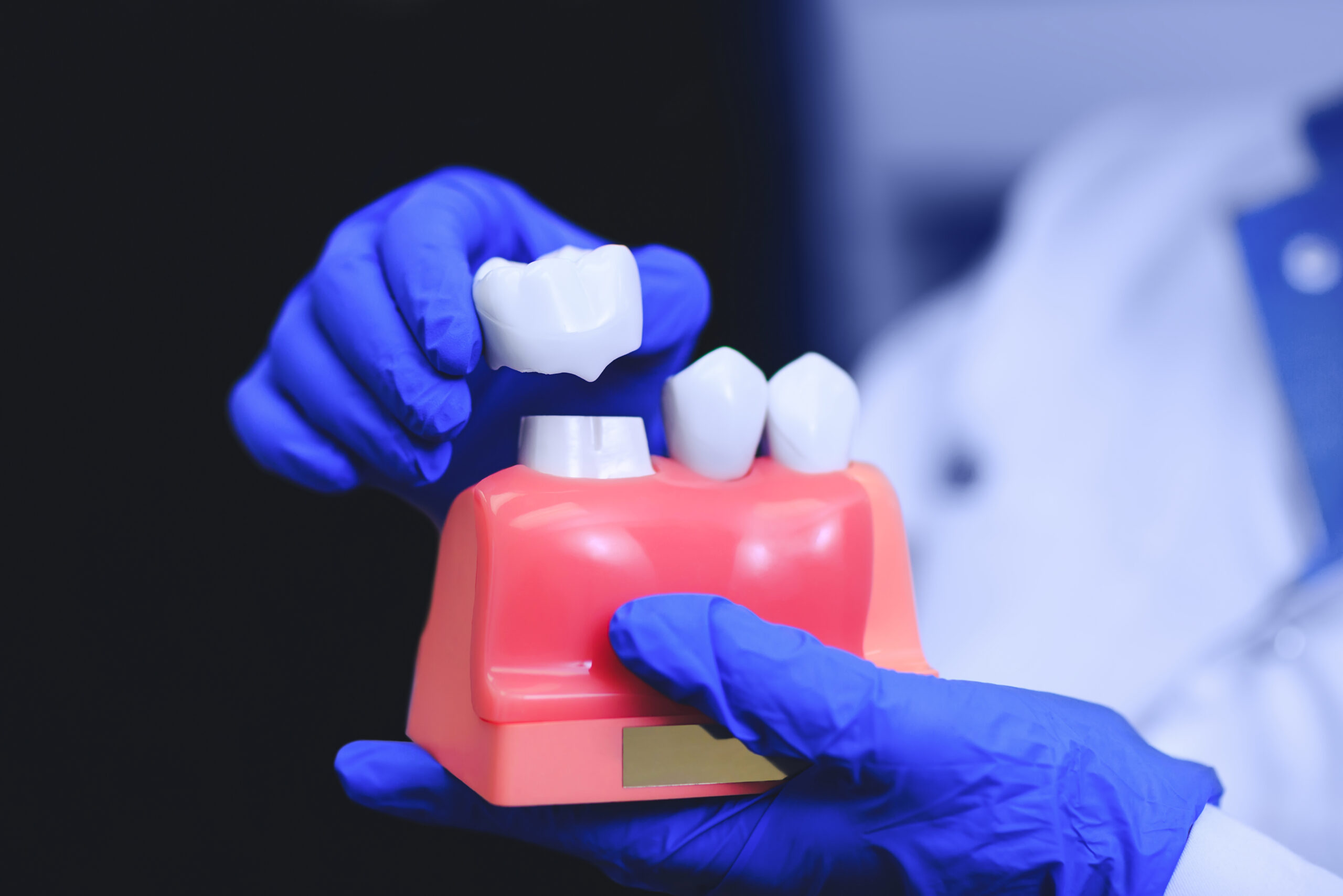 Dental Crowns