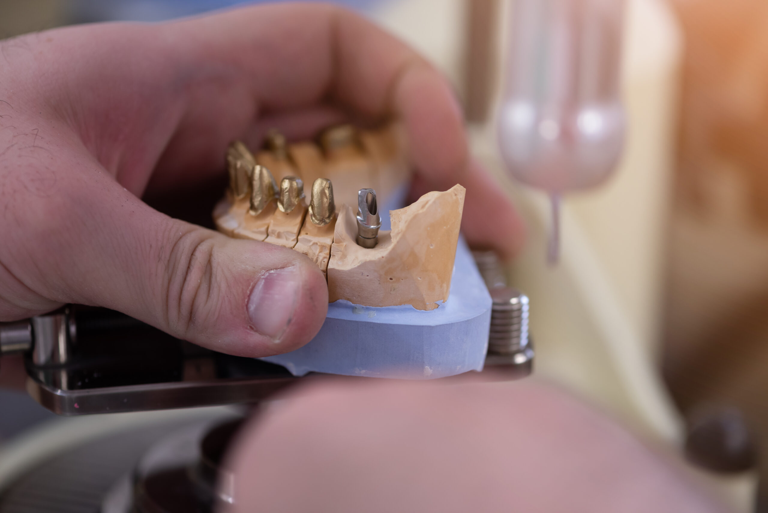 All-On-4 Dental Implants