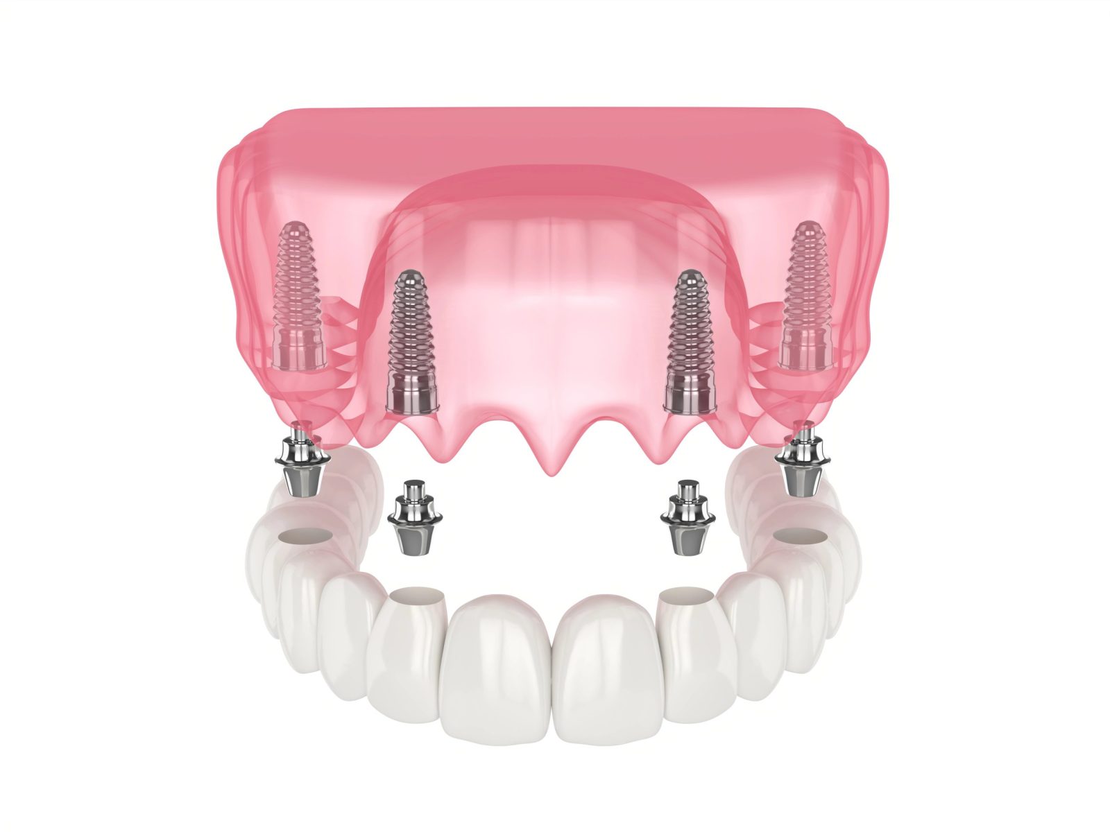 Best All on 4 Dental Implants Near Me: How to Choose the Right Provider