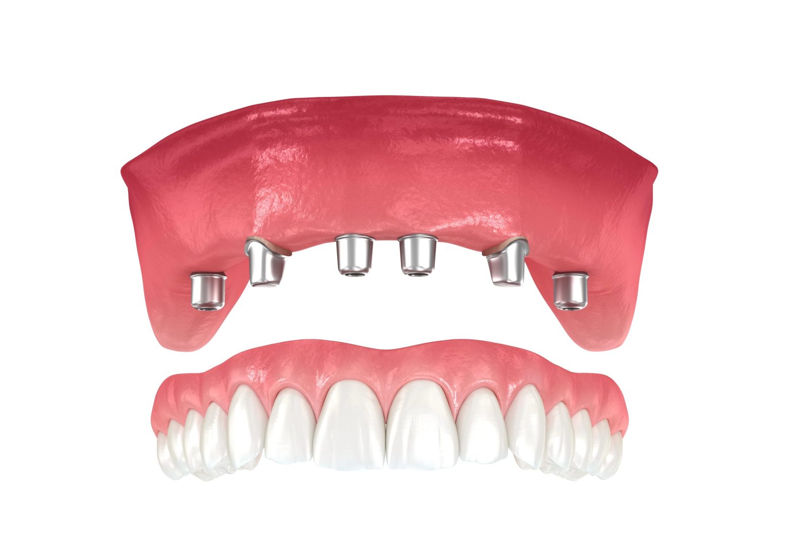How Long Do All on 4 Dental Implants Last? Longevity and Maintenance Tips