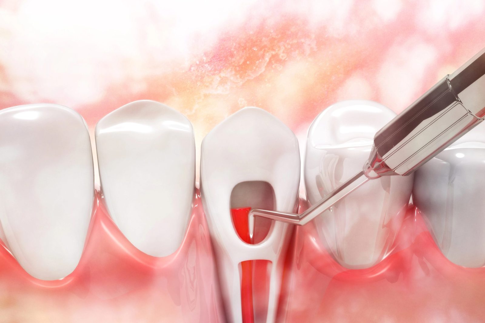 Periodontist Deep Cleaning Procedure: Targeted Treatment Below the Surface
