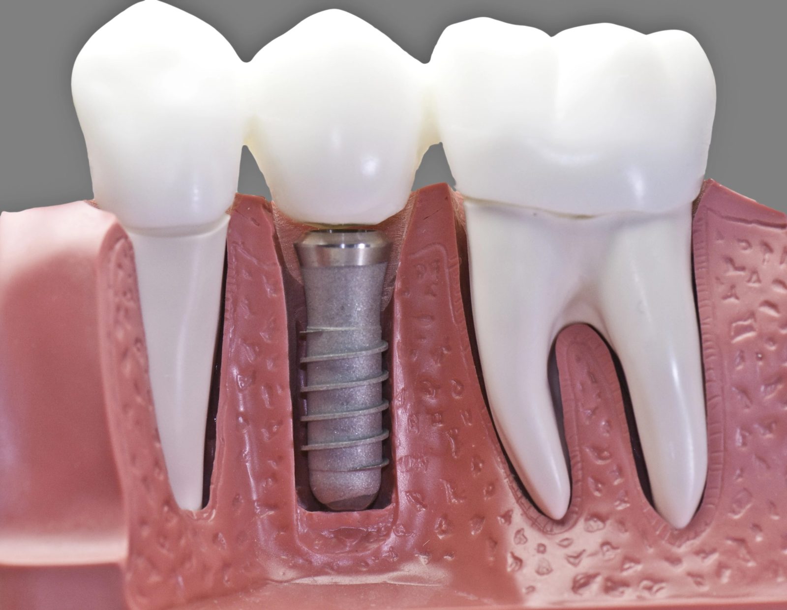 Single Tooth Dental Implant Solution: A Seamless Smile Restoration
