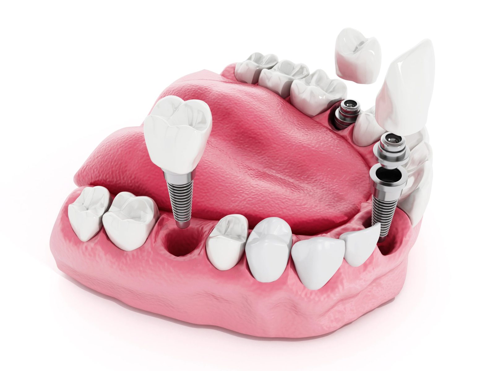 Full Mouth Dental Implants Options: Customized Solutions for Total Smile Makeovers