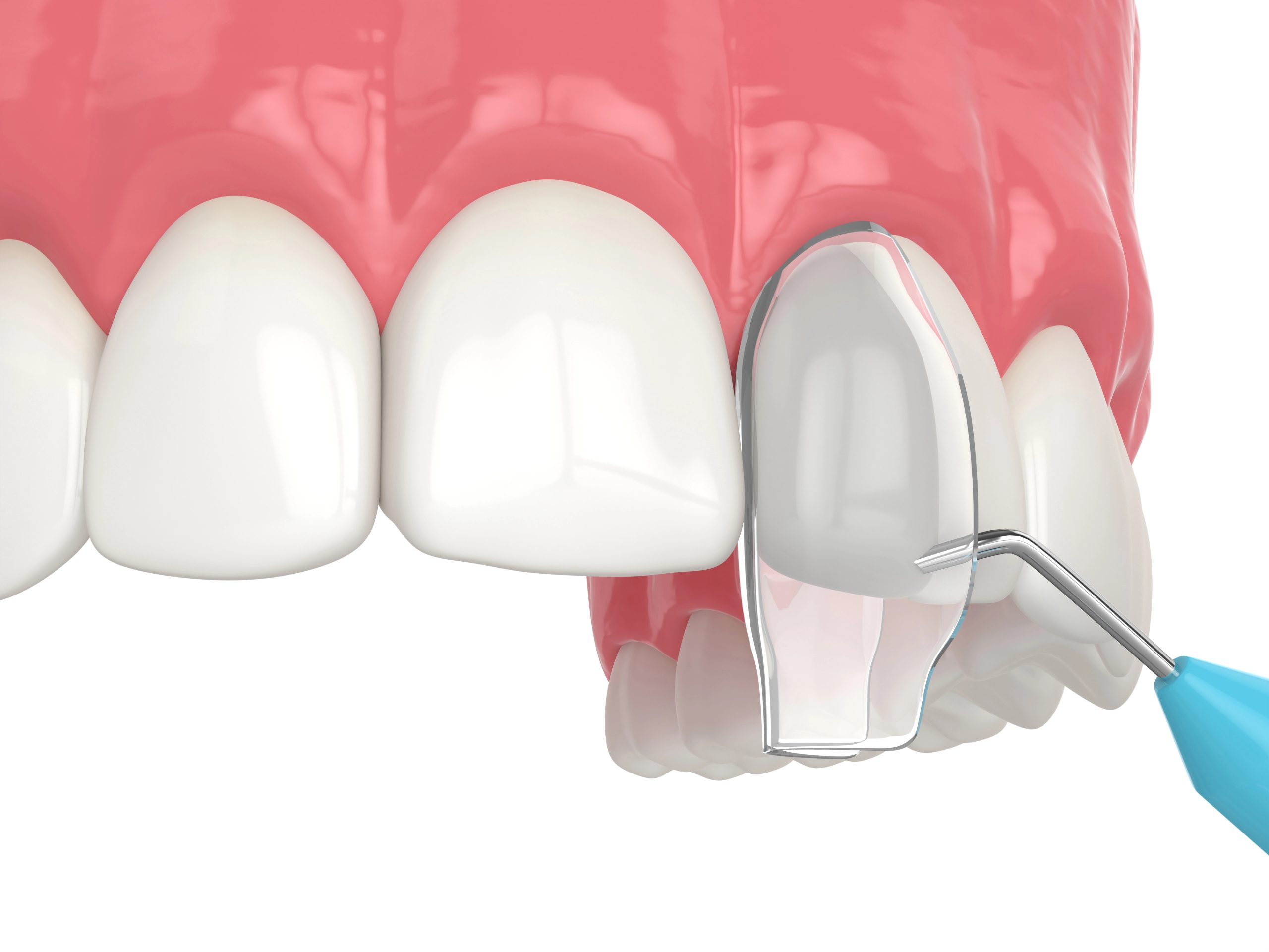 Cosmetic Bonding for Chipped Front Tooth: Restore Your Confidence