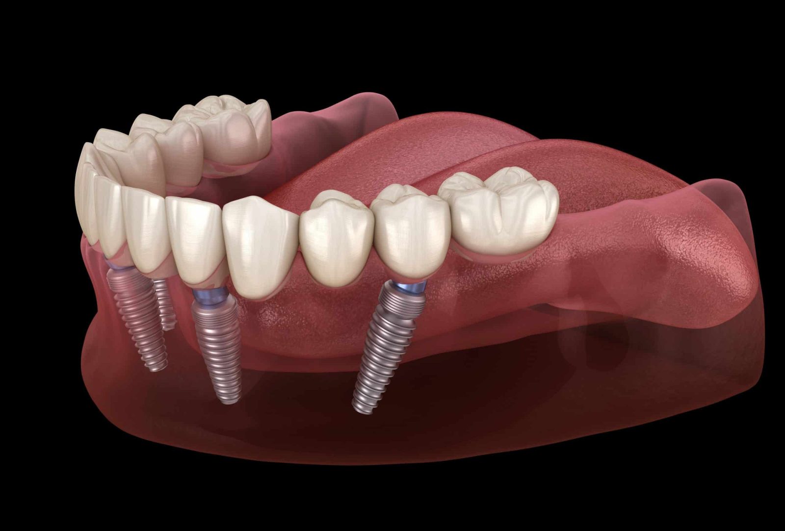 Thinking About All-on-4 Dental Implants? What to Expect at Your First Visit to The Dental Center of Jefferson