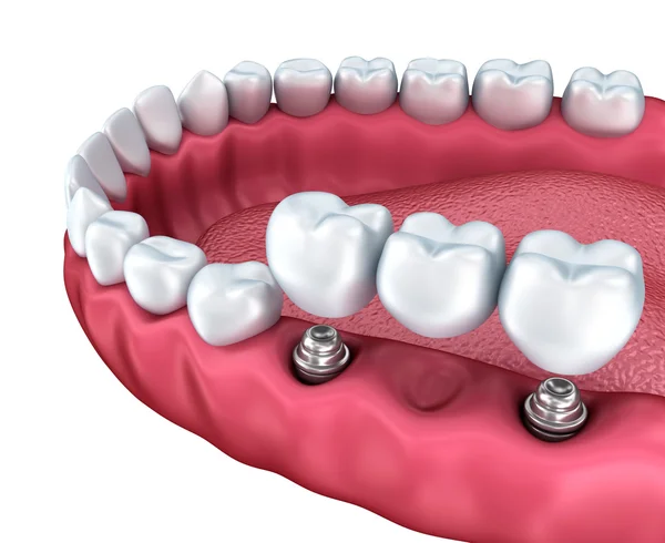 Understanding the Longevity of Dental Bridges for Patients in Lake Hopatcong NJ