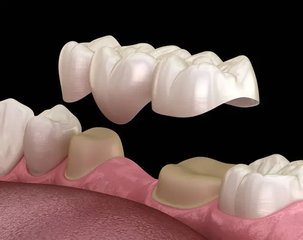 Discover the Benefits of Dental Bridges in Lake Hopatcong NJ for a Permanent Solution to Missing Teeth