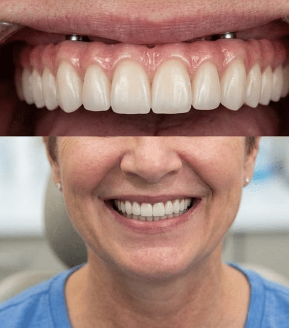 After Dental Implant Treatment