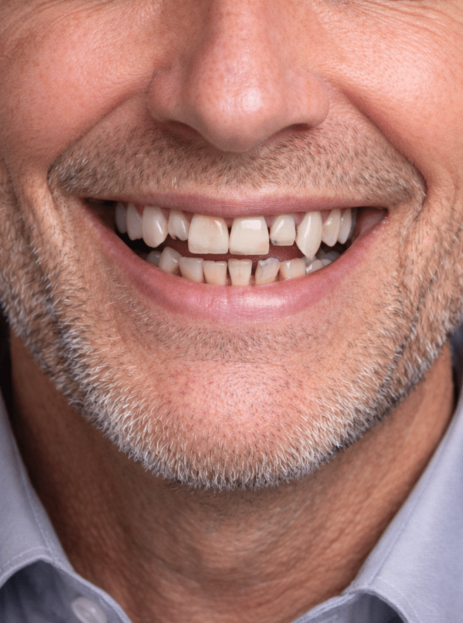 Before Dental Implant Treatment